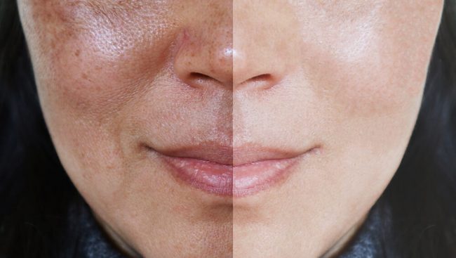 Treating Hyperpigmentation at Viso Medi Spa