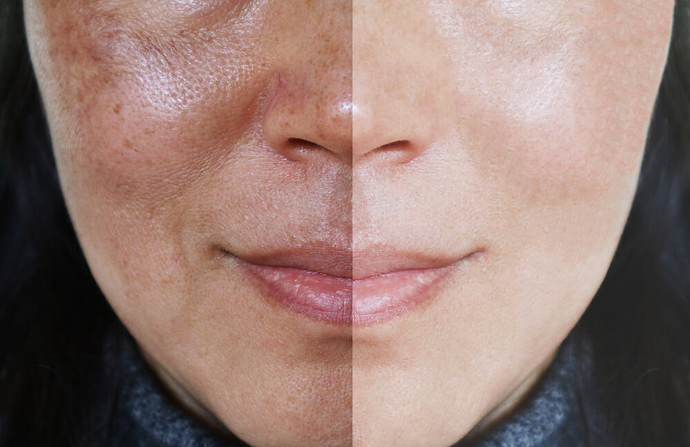 Treating Hyperpigmentation - Viso Medi Spa