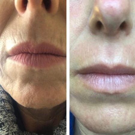 wrinkle around lip removal