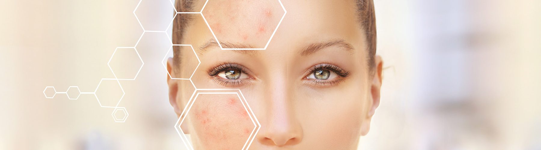 Post-Acne Marks /Treating Acne Scars