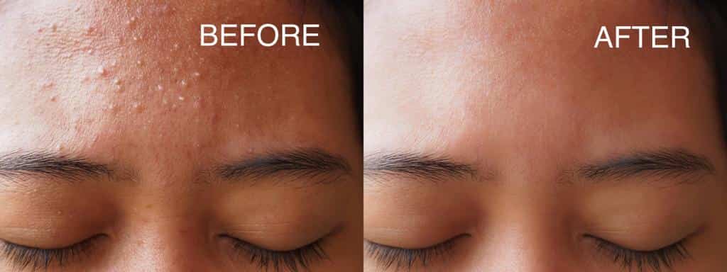 Hydrafacial Before and After