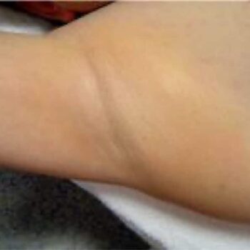 Armpit after laser Hair removal
