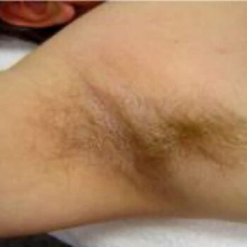 Armpit before laser Hair removal