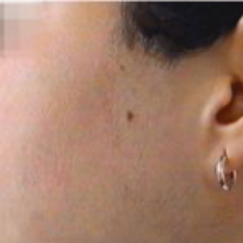 face after laser Hair removal
