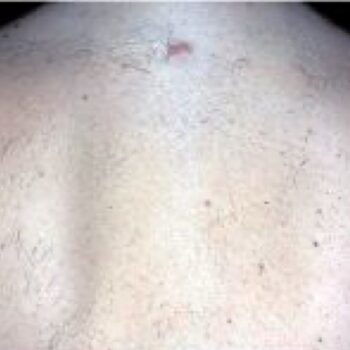 back after laser Hair removal